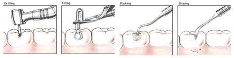 Treating Cavities and Types of Fillings – Part 2