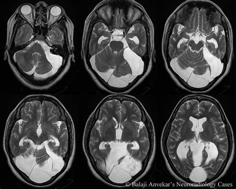 Dr Balaji Anvekar FRCR: Posterior Fossa Arachnoid cyst MRI