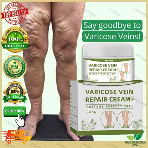 Varicose Veins Cream Treatment hilangkan urat bengkak urat angin urat timbul obat urat Varicose ...