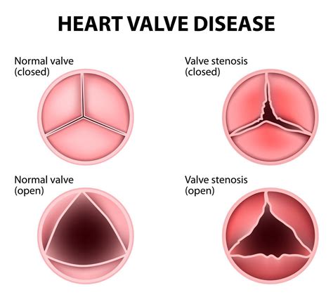 Heart Murmur Guide: Causes, Symptoms and Treatment Options