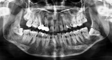 OPG X-ray In Bangalore | Get Evidence Based Dental Treatmeent