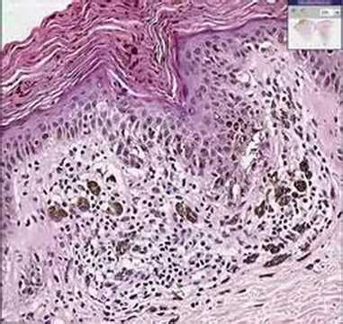 Compound Nevus Histology