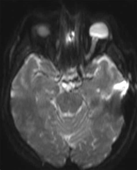 Optic Neuritis-MRI - Sumer's Radiology Blog