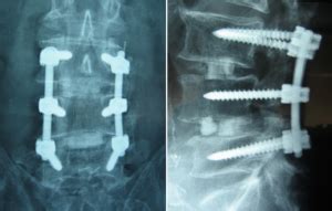 What Is A Lumbar Fusion? | Dr. Jason Attaman, Seattle Pain Management Doctor