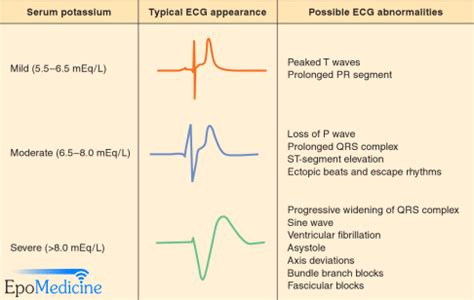 ECG changes in Hyperkalemia | Epomedicine