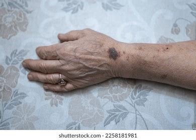 Bruises On Hand Elderly Woman Wrinkled Stock Photo 2258181981 ...