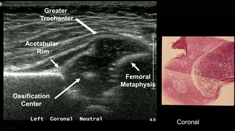 Developmental Dysplasia Of The Hip Ultrasound