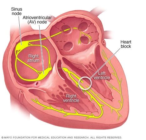 Bundle branch block - Mayo Clinic