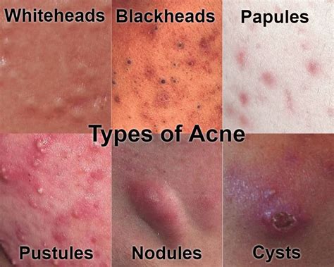 Acne • Repair & Rejuvenate Acne Skin • NASCENT Skin Clinic