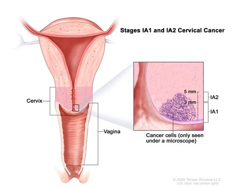 Cervical Cancer Stages