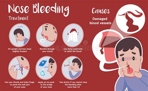 Nose Bleeding Cartoon Vector Stock Vector - Illustration of bleed ...