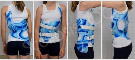 Cheneau-Gensingen Brace | Scoliosis Brace | TLSO | Cheneau Brace