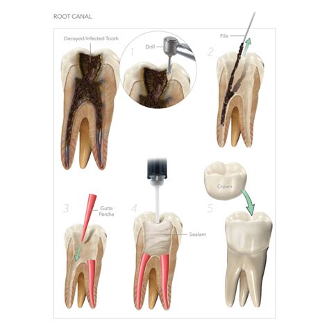 Root Canals - Boston Dental