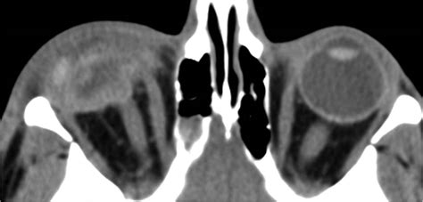 Radiologist For Ever: Orbital rule 11 : Rupture globe