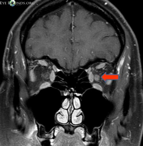 Optic neuritis: from one medical student to another medical student