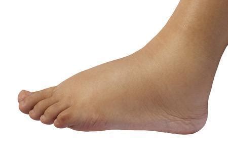 7 Reasons for Swelling in Feet and Ankles: Affiliated Foot & Ankle Care ...