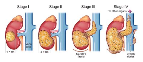 Best Kidney Cancer Treatment In Pathankot | Best Prostate Cancer Treatment In Pathankot | Best ...