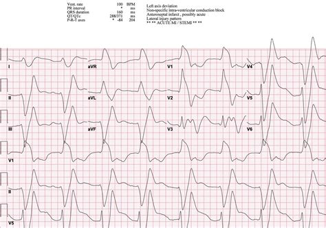 Ecg