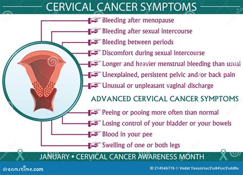 Cervical Cancer Symptoms Infographic Vector Illustration ...