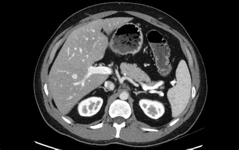 Abdominal CT: spleen and adrenal glands • LITFL • Radiology