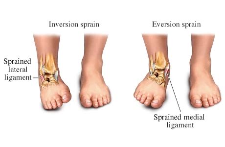 Anatomy - eversion ankle sprain