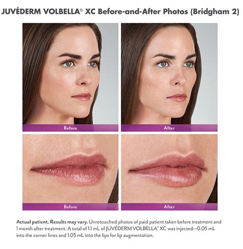 Juvederm Voluma In Lips | Lipstutorial.org