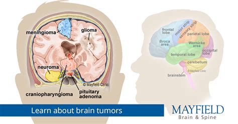 Most Common Primary Brain Tumor