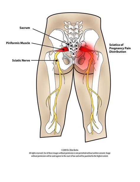 Types Of Dental Treatment: Sciatic Nerve Damage Treatment Options