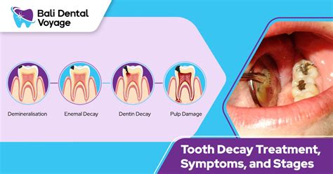 Tooth Decay Symptoms, Stages, and the Treatment