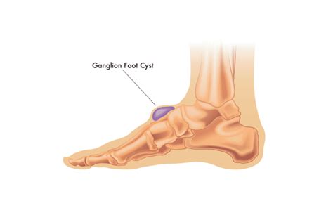 How to Deal with a Ganglion Cyst - Feet By Pody