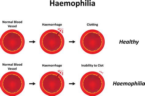 Hemophilia: MedlinePlus Genetics