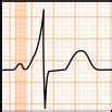 File:Short PR interval (ECG).svg - Wikiversity