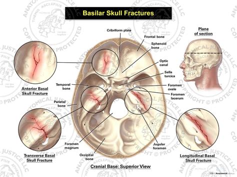 Basilar skull fracture,WHAT TO KNOW?