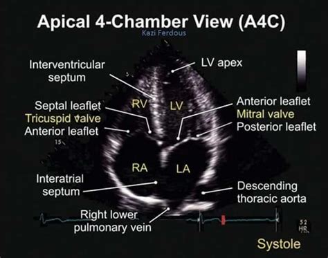 Four Chambers Of The Heart Ultrasound - Photos Idea