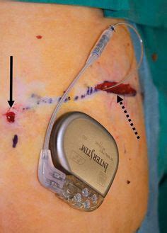 1000+ images about Interstim Sacral Neuromodulation on Pinterest | Drawings of, Arrows and Therapy