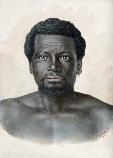 Leprosy: the early stages in an African man: a head and … free public domain image | Look and Learn