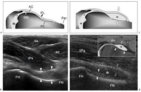 Anterior Hip Joint Ultrasound