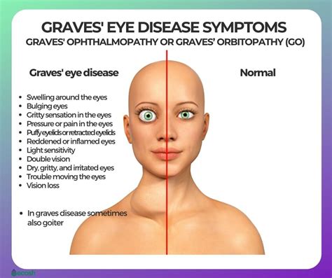 GRAVES' DISEASE - Symptoms, Causes, Risk Groups, Conventional Treatment, Diet and Home Remedies ...