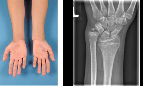 Pediatric Distal Radius Fractures | Musculoskeletal Key