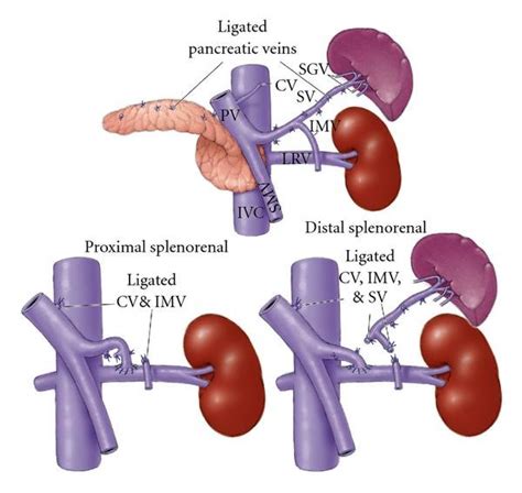 DISTAL SPLENORENAL SHUNT PDF