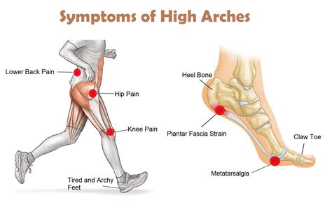 Best Orthotic Insoles for High Arches