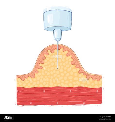 Subcutaneous Injection