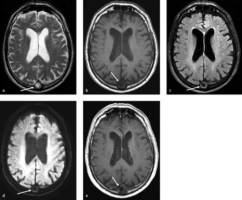 Arachnoid Granulations