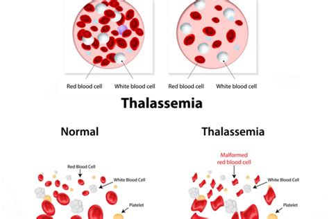 Living with thalassemia