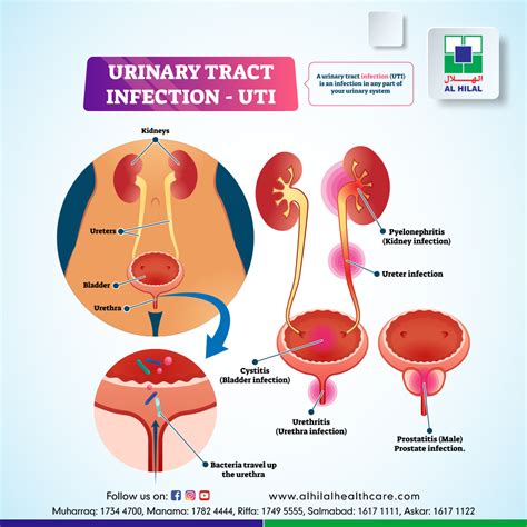 Urinary Tract Infection (UTI)