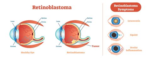 Potential treatment for eye cancer using tumor-killing…