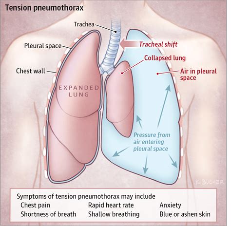 Pneumothorax Causes, Symptoms and Treatment | Mediologiest