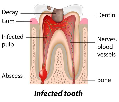 Abscessed Teeth - Southlake Endodontics