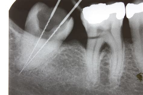 File:Dental X-ray 72.JPG