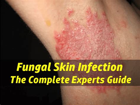 Skin Fungus Infection - Are You Treating The Cause or The Symptoms